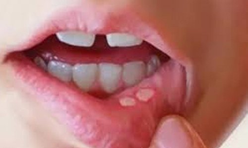 Mouth Ulcer Problem